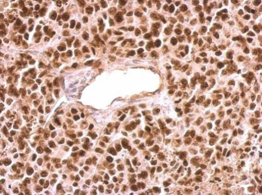 PARP1 antibody [N2C1], Internal detects PARP1 protein at nucleus on HeLa xenograft by immunohistochemical analysis. Sample: Paraffin-embedded HeLa xenograft. PARP1 antibody [N2C1], Internal (GRP506) dilution: 1:500.