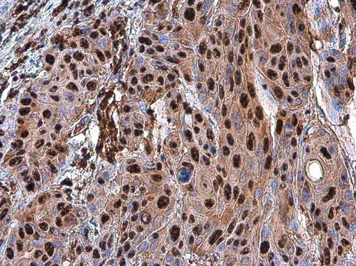 PARP antibody detects PARP protein at nucleus in human oral carcinoma by immunohistochemical analysis. Sample: Paraffin-embedded human oral carcinoma. PARP antibody (GRP464) diluted at 1:500.