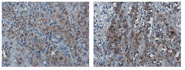 PD-L1 antibody detects PD-L1 protein at cell membrane in human ovarian carcinoma by immunohistochemical analysis.  Antibodies: PD-L1 antibody (GRP487) diluted at 1:1000, and competitor's antibody diluted at 1:50.