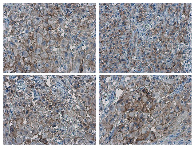 PD-L1 antibody detects PD-L1 proteinat cell membrane in human ovarian carcinoma by immunohistochemical analysis. Sample: Paraffin-embedded human ovarian carcinoma. PD-L1 antibody (GRP487) diluted at 1:1000.