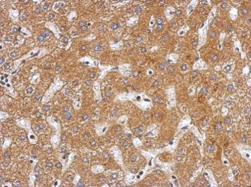 Immunohistochemical analysis of paraffin-embedded human hepatoma, using Plasminogen(GRP481) antibody at 1:500 dilution.