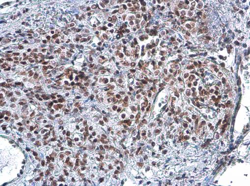 Rad50 antibody [13B3] detects Rad50 protein at nucleus by immunohistochemical analysis.Sample: Paraffin-embedded human lung cancer.Rad50 stained by Rad50 antibody [13B3] (GRP541) diluted at 1:100.Antigen Retrieval: Citrate buffer, pH 6.0, 15 min