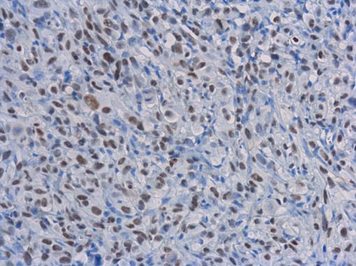 Rad50 antibody [13B3] detects Rad50 protein at nucleus in PC-3 xenograft by immunohistochemical analysis. Sample: Paraffin-embedded PC-3 xenograft. Rad50 antibody [13B3] (GRP541) diluted at 1:200.