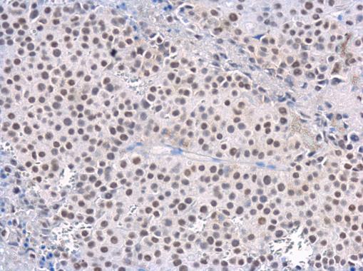 Rad50 antibody [13B3] detects Rad50 protein at nucleus in CAL 27 xenograft by immunohistochemical analysis. Sample: Paraffin-embedded CAL 27 xenograft. Rad50 antibody [13B3] (GRP541) diluted at 1:200.
