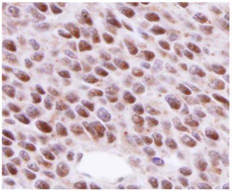 RAD51 antibody 14B4 (GRP542) detects RAD51 in nucleus on BT483 xenograft by immunohistochemical analysis.  Sample: Paraffin-embedded BT483 xenograft.RAD51 antibody 14B4 (GRP542) dilution: 1:200.
