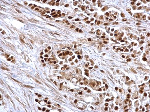 Rb antibody detects Rb protein at nucleus on human colon carcinoma by immunohistochemical analysis. Sample: Paraffin-embedded human colon carcinoma. Rb antibody (GRP463) dilution: 1:500.