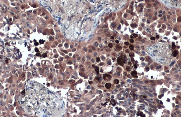 SQSTM1 / P62 antibody [N3C1], Internal detects SQSTM1 / P62 protein at cytoplasm by immunohistochemical analysis.Sample: Paraffin-embedded human lung cancer.SQSTM1 / P62 stained by SQSTM1 / P62 antibody [N3C1], Internal (GRP467) diluted at 1:500.Antigen R