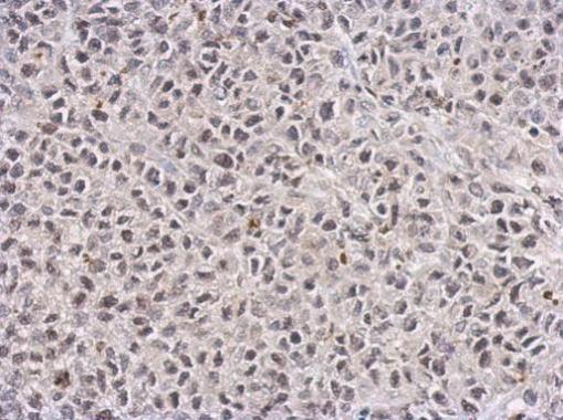 TET1 antibody [GT1462] detects TET1 protein at nucleus on HeLa xenograft by immunohistochemical analysis. Sample: Paraffin-embedded HeLa xenograft. TET1 antibody [GT1462] (GRP530) dilution: 1:100.