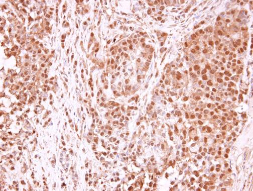 TET1 antibody [N3C1] detects TET1 protein at nucleus in human A549 xenograft by immunohistochemical analysis. Sample: Paraffin-embedded human A549 xenograft . TET1 antibody [N3C1] (GRP515) diluted at 1:250.
