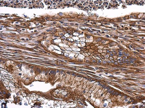 TNF alpha antibody detects TNF alpha protein at membrane on human gastric carcinoma by immunohistochemical analysis. Sample: Paraffin-embedded human gastric carcinoma. TNF alpha antibody (GRP497) dilution: 1:500.