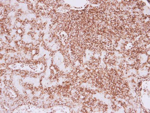 Vimentin antibody detects Vimentin protein at cytoplasm in human lung adenocarcinoma by immunohistochemical analysis. Sample: Paraffin-embedded human lung adenocarcinoma. Vimentin antibody (GRP465) diluted at 1:500.